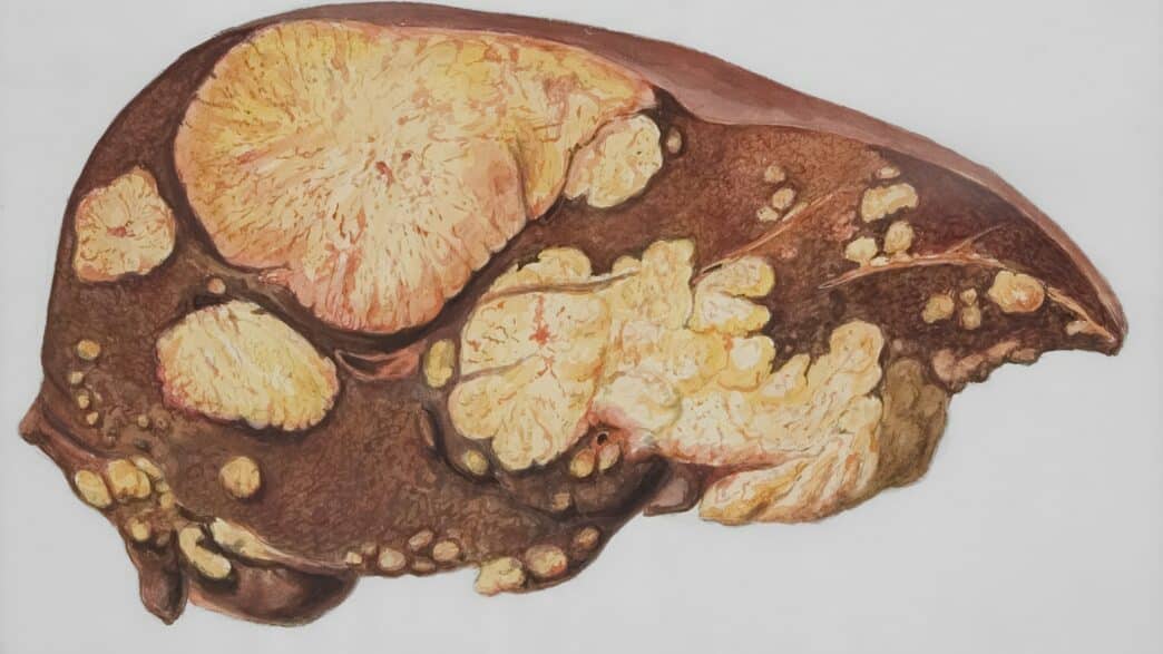 27 microbes liés au cancer du pancréas